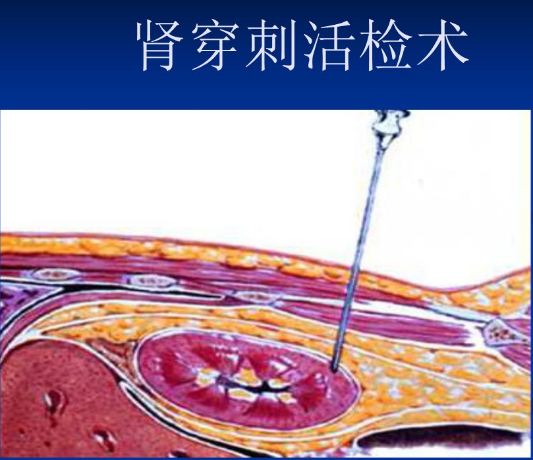 什么是肾穿刺?肾穿刺有何临床意义?(图1)